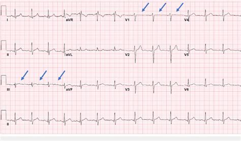 nonspecific st changes on ekg.